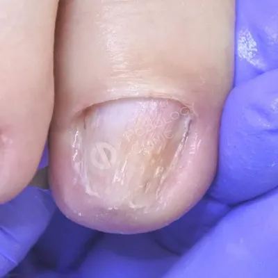 Микронихия – как лечить укороченные ногти, способы профилактики проблемы