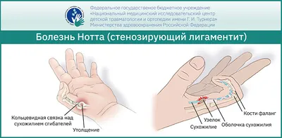 Шишка на пальце руки: причины, симптомы и лечение