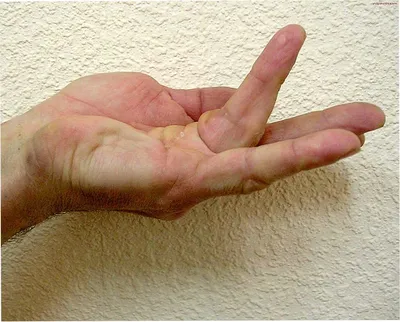 Боль в суставе большого пальца на руке: причины и способы лечения,  особенности боли при сгибании и заболевания пальца