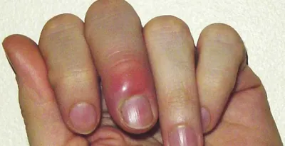 Диагностика и лечение онихолизиса ногтей в Санкт-Петербурге | Центр  Подологии