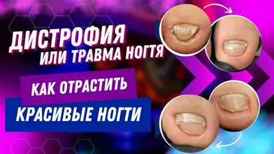 Подногтевой экзостоз лечение в Перми | Консультация ортопеда