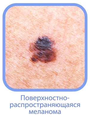 Дерматофиброма: гистология, фото, лечение | Удаление дерматофибромы кожи  лазером / скальпелем в Клинике подологии Полёт в Москве