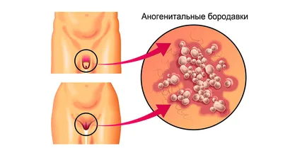 Как избавиться от папиллом | Блог Daily Medical