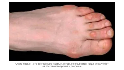Мозоли на ногах (лечение мозолей в Днепропетровске) Украина