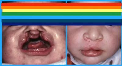 Красные точки на небе у взрослого и ребенка – 1 стоматологическая причина и  10 дополнительных