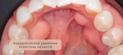 Экзостоз челюсти [симптомы, лечение и удаление остеофита в стоматологии]