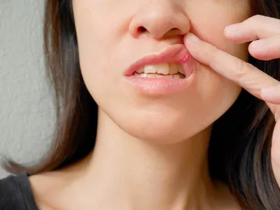 Туберкулез полости рта - причины, симптомы, диагностика, лечение
