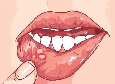 Фиброма полости рта – удаление фибромы лазером