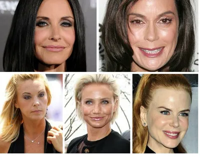 Bad Botox. Как выглядят негативные последствия инъекций ботокса на лицах  знаменитостей | Beauty-consult | Дзен