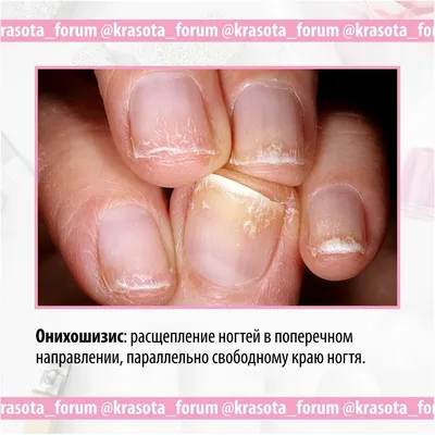 Instagram-এ Deryabina Irina Gennadevna: \"Негрибковые заболевания ногтей  могут быть вызваны различными факторами, включая: 1️⃣Механические  повреждения: Чрезмерное ношение обуви, неправильное стрижение ногтей,  травмы могут повредить ногти и привести к ...