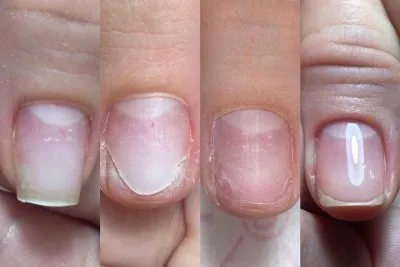 Онихолизис ногтя - что это за болезнь? | Причины появления онихолизиса и  лечение | Как отличить онихолизис от грибка - Фото