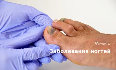 Причины появления желтых ногтей на большом пальце ноги и способы их  устранения
