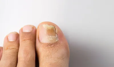 Шелушится кожа на ногах: причины появления шелушения, сухости, зуда стоп и  пальцев, лечение микоза