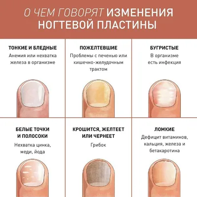 Медицинский маникюр при грибке (ФОТО) - trendymode.ru