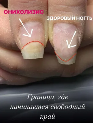 Nogotokprofessional - В кабинет nail-мастера часто приходят клиенты с  различными проблемами. Сегодня хотим поговорить с вами о НЕ грибковых заболеваниях  ногтей.⠀ ⠀ Сохраняйте, чтобы не потерять пост 💛⠀ ⠀ Есть видов не