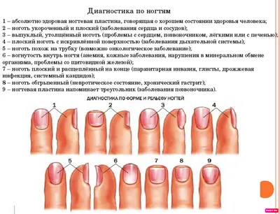 Лечение ногтей. Виды, симптомы, диагностика заболеваний.