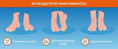 Болезни ногтей: виды, симптомы, лечения и профилактика - FitoBlog