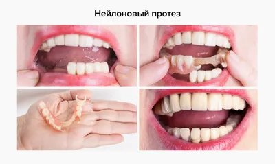 Мостовидный зубной протез, цена на установку мостовидного протеза в СПб в  стоматологии