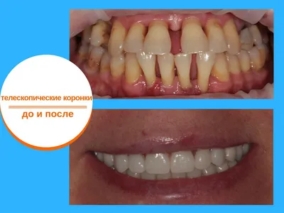 Реабилитация зубов с верхним и нижним протезом до и после лечения стоковое  фото ©Marina113 192514698