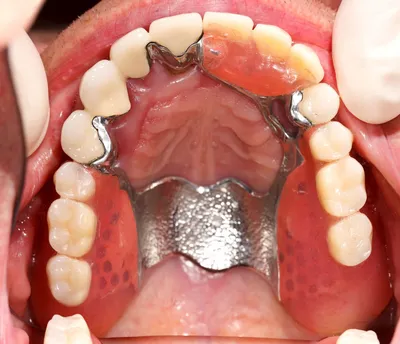 Какой протез выбрать при отсутствии всех зубов - Хирургическая стоматология