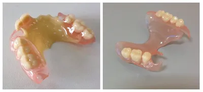 Нейлоновые протезы в Волжском в стоматологии ДАША