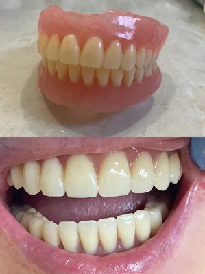 Нейлоновые зубные протезы в Москве – цены, отзывы на установку в  стоматологических клиниках Зуб.ру