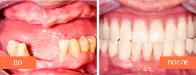 Стоматолог - Микра протез нейлоновый (гелевый) До и после🔥👍 | Facebook