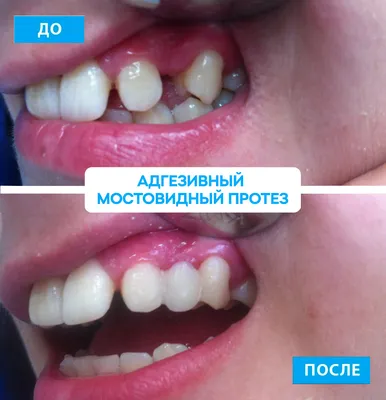 Нейлоновые зубные протезы: цена (Харьков, Leo Dent)
