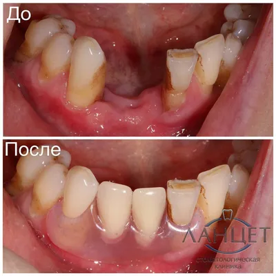 Нейлоновые зубные протезы : особенности, преимущества, цены в стоматологии  Дента-Профессионал
