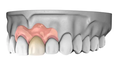 Нейлоновые зубные протезы в Томске - Цены, Фото, Отзывы ⚡