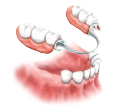 Какой протез выбрать при отсутствии всех зубов - Хирургическая стоматология