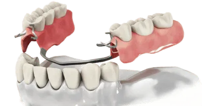 Съемное протезирование зубов в СПБ, цена на съемные зубные протезы