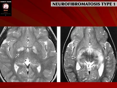 Нейрофиброматоз - мутация в 17-й хромосоме | Пикабу