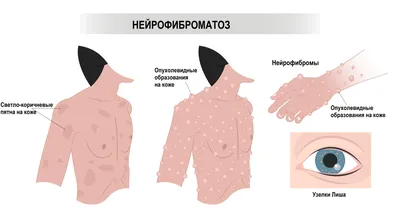 Нейрофиброматоз - Педиатрия - Справочник MSD Профессиональная версия