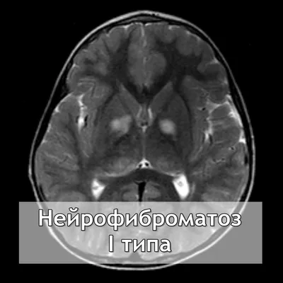 Орфанные заболевания. Нейрофиброматоз в России: вчера, сегодня, завтра. |  Дискуссионный клуб БФ Кораблик