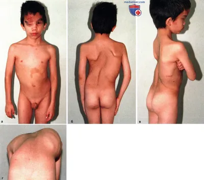 Файл:Neurofibroma02.jpg — Википедия