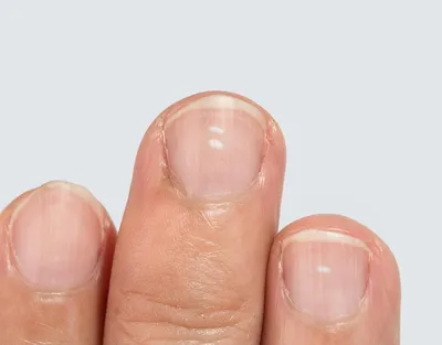 Блог :: Почему слоятся ногти и как их вылечить?