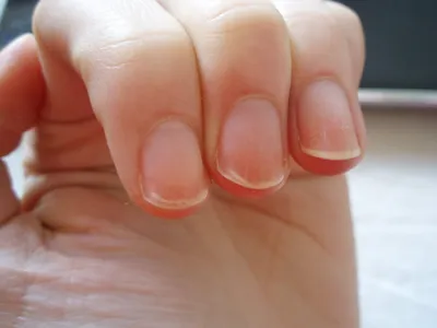Из-за чего ногти становятся ребристыми – что делать, способы лечения и  профилактики