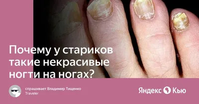 закрыть некрасивые ногти стоковое изображение. изображение насчитывающей  страшно - 216983527