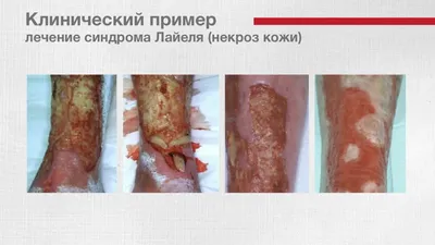 Клиника Синицкой on Instagram: \"💉 История одной внутримышечной инъекции в  бедро (неудачно выполненной). ⠀ 😱 Пациентка самостоятельно выполнила  внутримышечную инъекцию (в бедро) противоспалительного препарата, после  чего на бедре сформировался ...