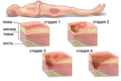 Влажная гангрена – симптомы, причины, признаки, диагностика и лечение  болезни | «Будь Здоров»