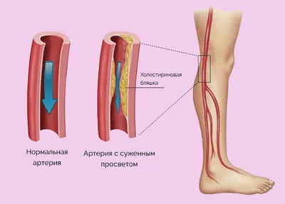 Диабетическая стопа: симптомы, причины, диагностика и лечение в лучших  клиниках - MedTour