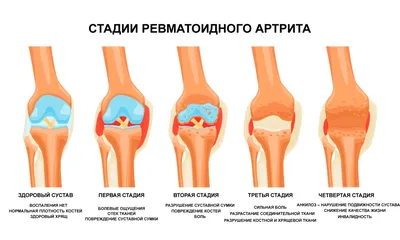 Атеросклероз нижних конечностей - симптомы и лечение в СПб | Клиника  МедПросвет