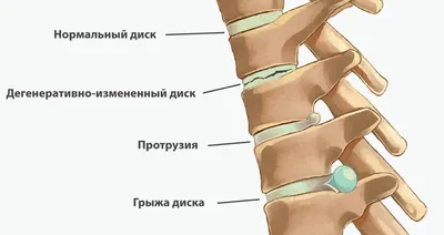 Как распознать варикоз на начальных стадия? - «Институт Вен» лечение  варикоза в Киеве и Харькове