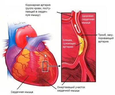 Стадии пролежней