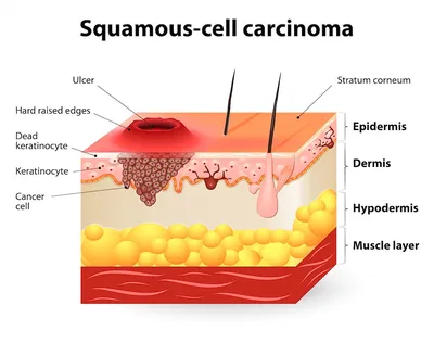 Плоскоклеточный Рак Кожи — стоковые фотографии и другие картинки Клетка -  часть организма - Клетка - часть организма, Рак кожи, Меланома - iStock