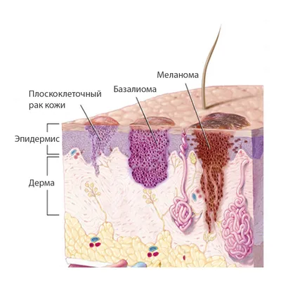 Лечение плоскоклеточного рака кожи