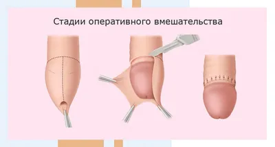 Microscopic Replantation of Penile Glans Amputation Due to Circumcision |  Protocol (Translated to Russian)