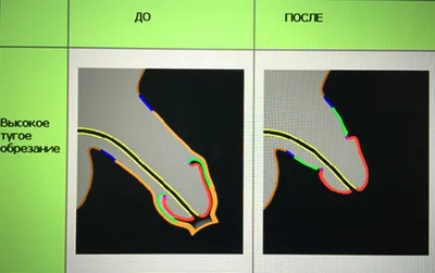 Фимоз у мужчин лечится обрезанием крайней плоти | 18+