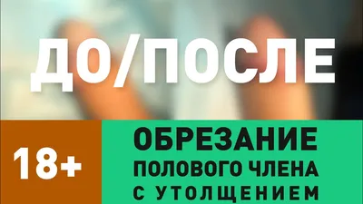 Обрезание крайней плоти в Санкт-Петербурге